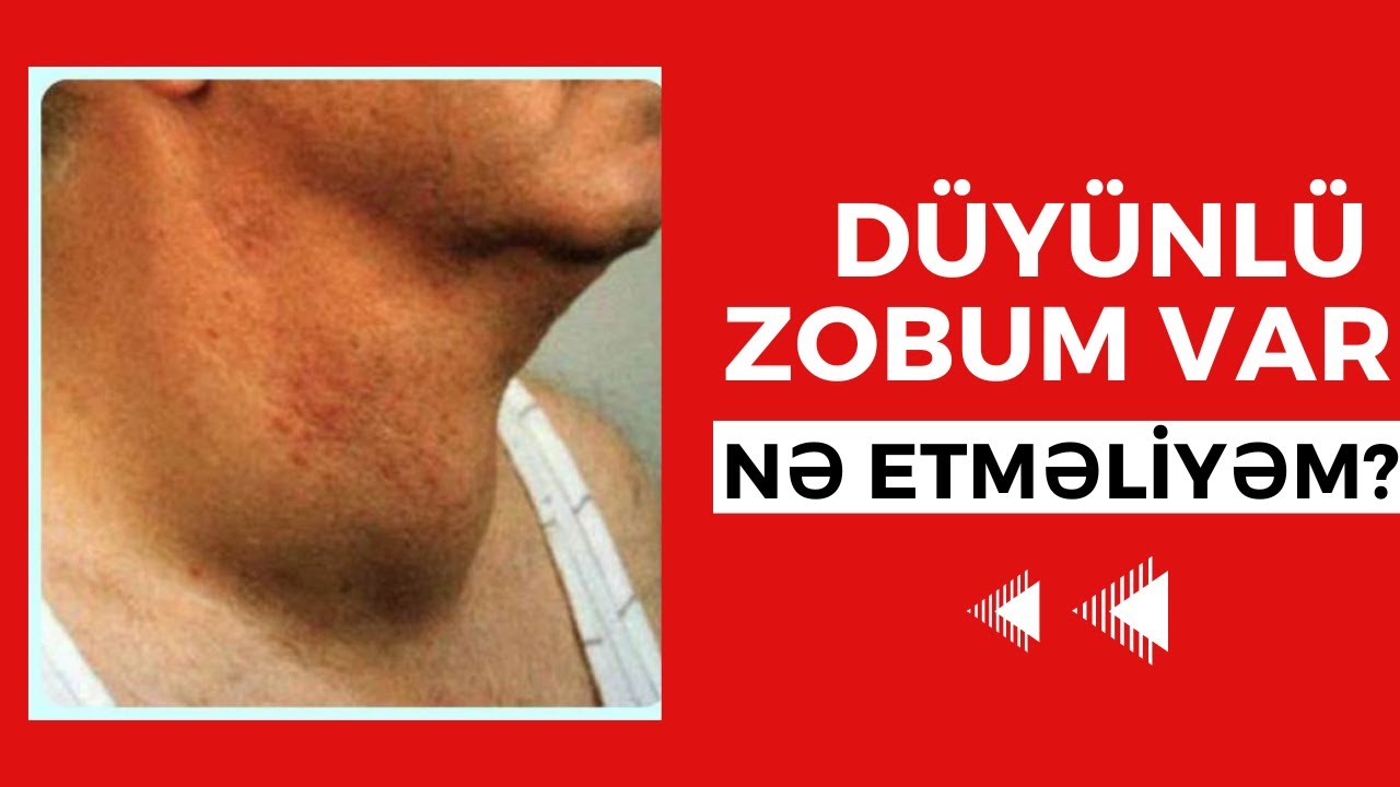 Düyünlü Zobum Var - Nə Etməliyəm?
