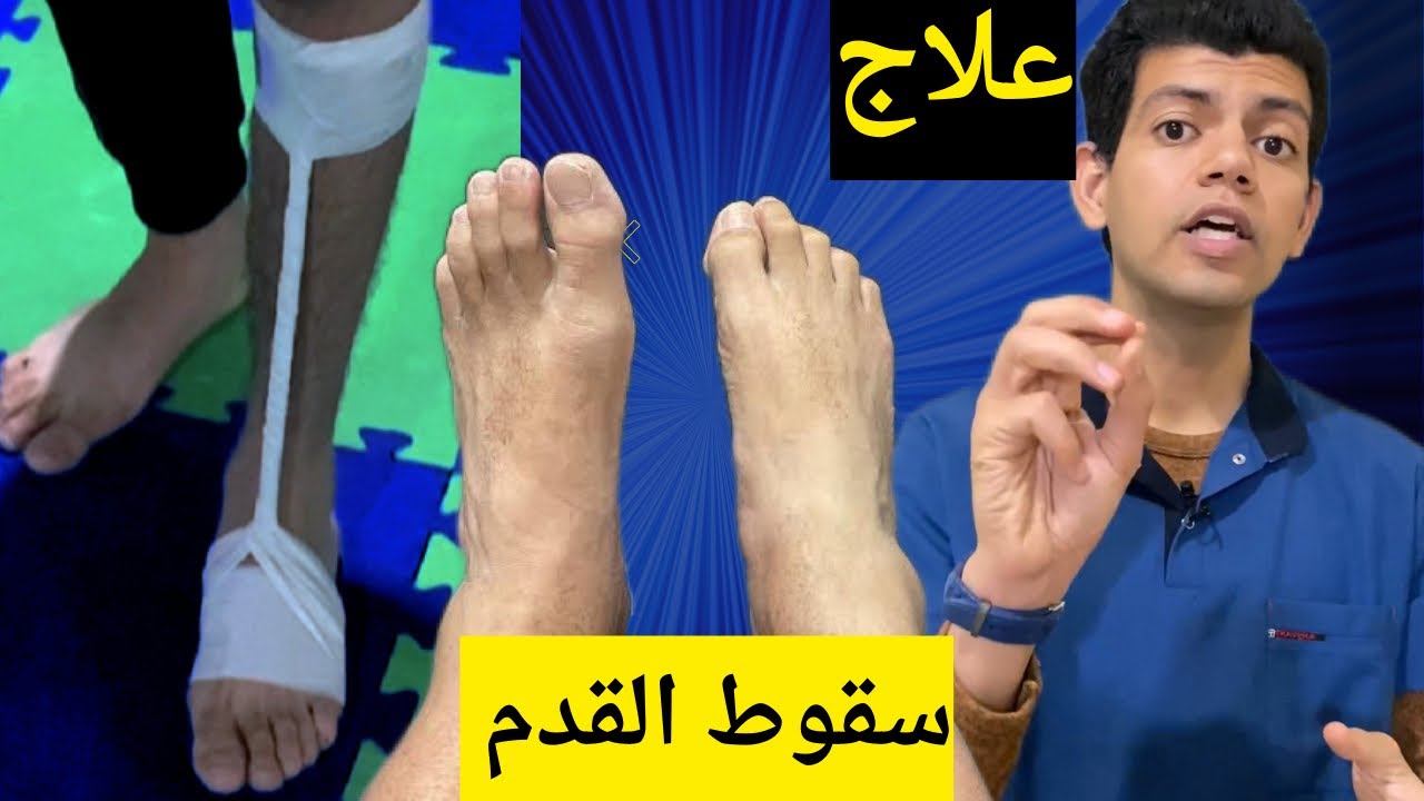 علاج سقوط القدم /تثبيت القدم