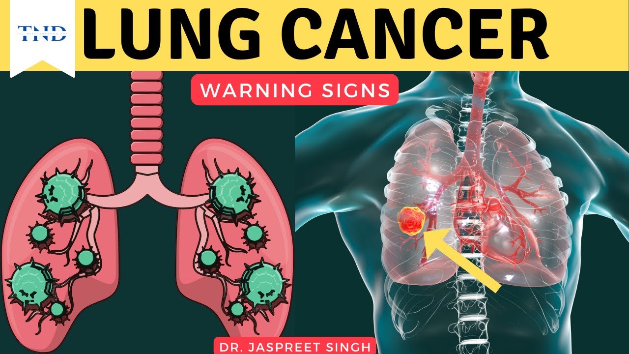 Lung cancer warning signs don't ignore these!