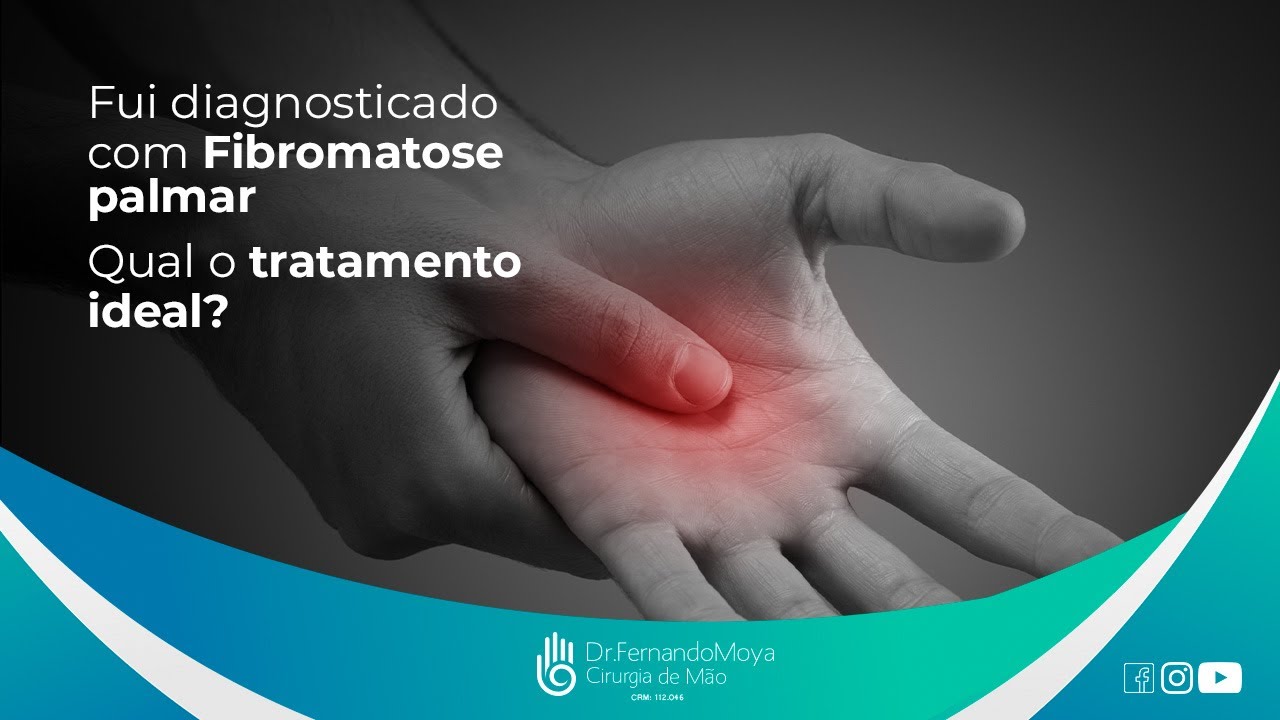 Fui diagnosticado com Fibromatose palmar. Qual o tratamento ideal?  | Dr. Fernando Moya CRM 112046