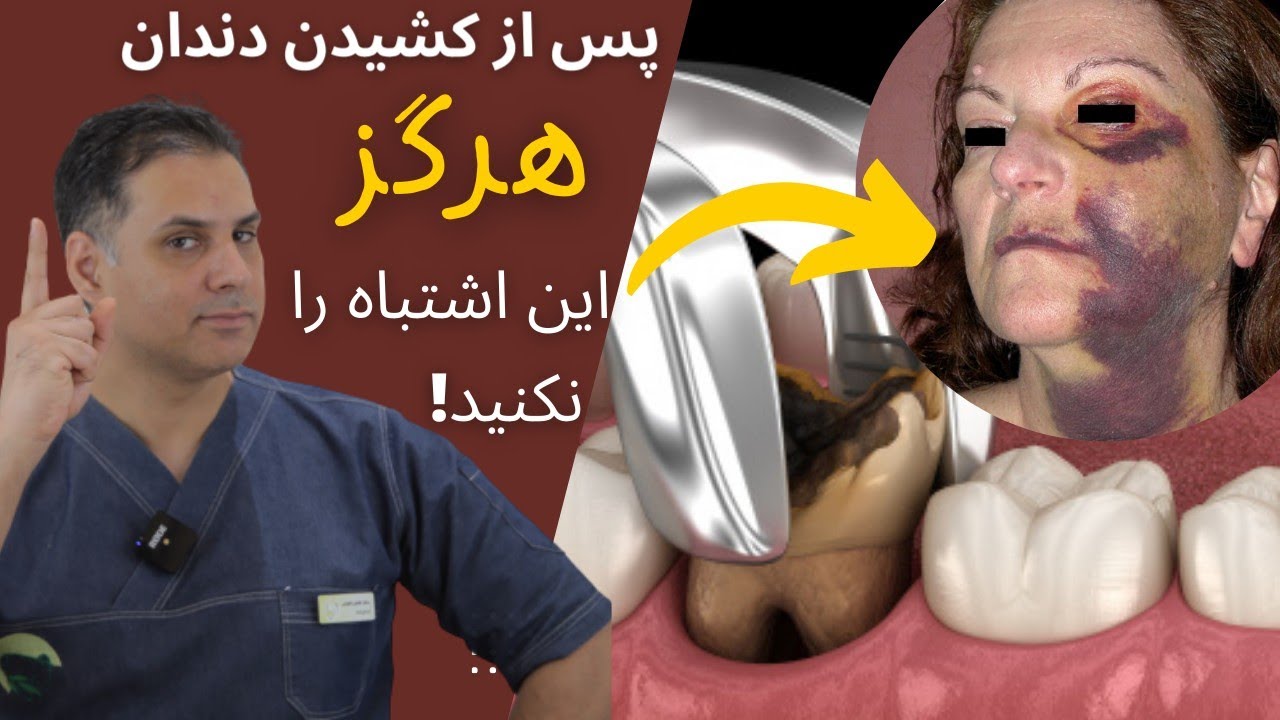 روش درست مراقبت، پس از کشیدن دندان و یا انجام جراحی | چگونه عوارض پس از جراحی ایمپلنت را کاهش دهیم