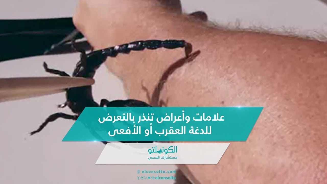 علامات وأعراض تنذر بالتعرض للدغة العقرب أو الأفعى