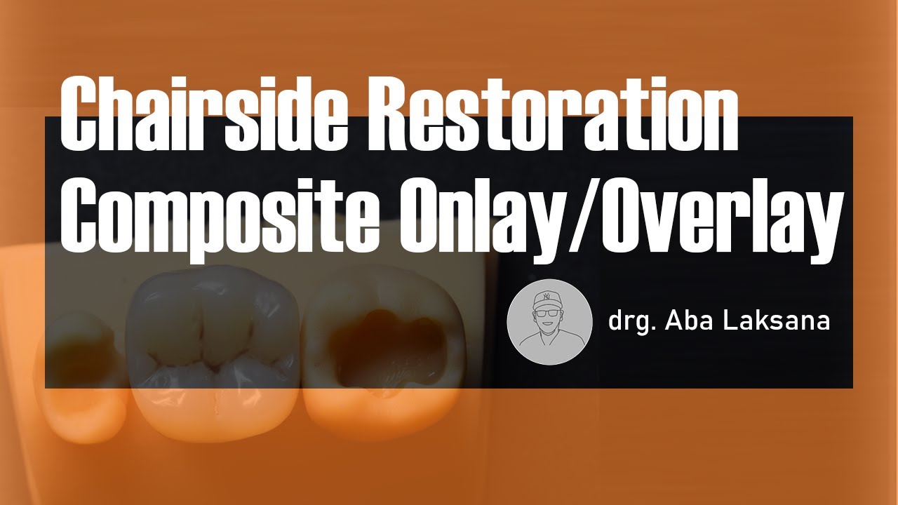 Chairside Composite Inlay/Onlay/Overlay | Semidirect Restoration (Die Silicone ❌ Polofil NHT)❗️ VOCO