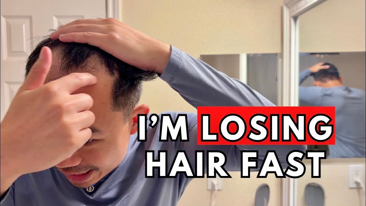 Regrowing My Receding Hair Sucks...Here’s My New Plan