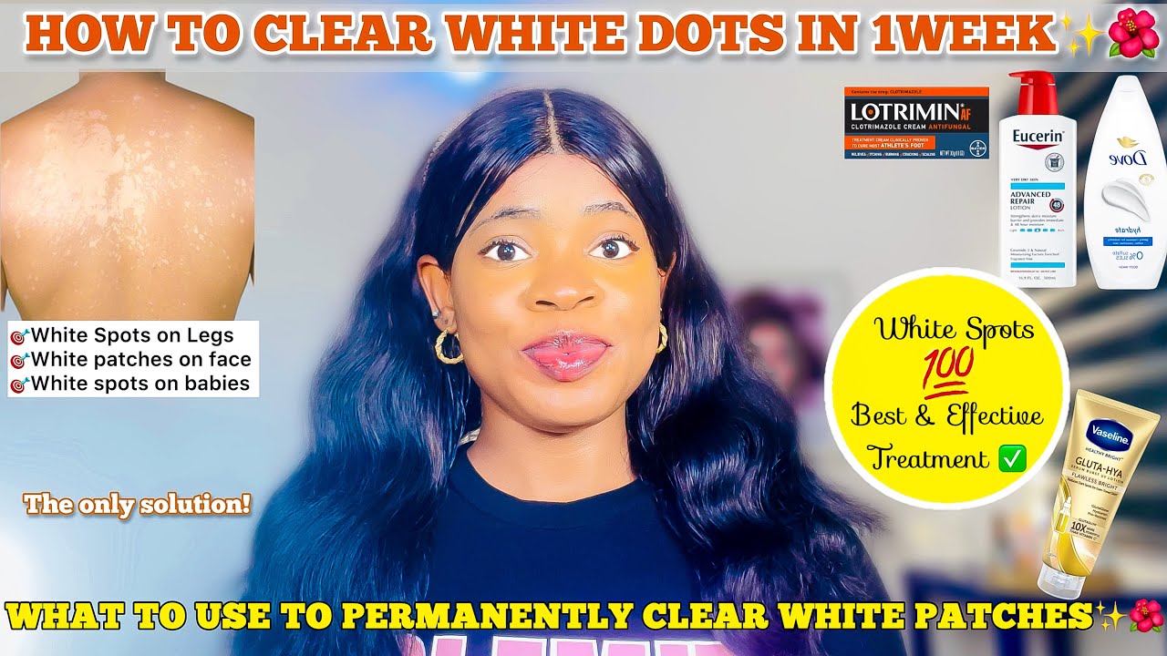 HOW TO GET RID OF WHITE DOTS ON SKIN ✅ Effective Treatment for White Patches on Skin & Best Products