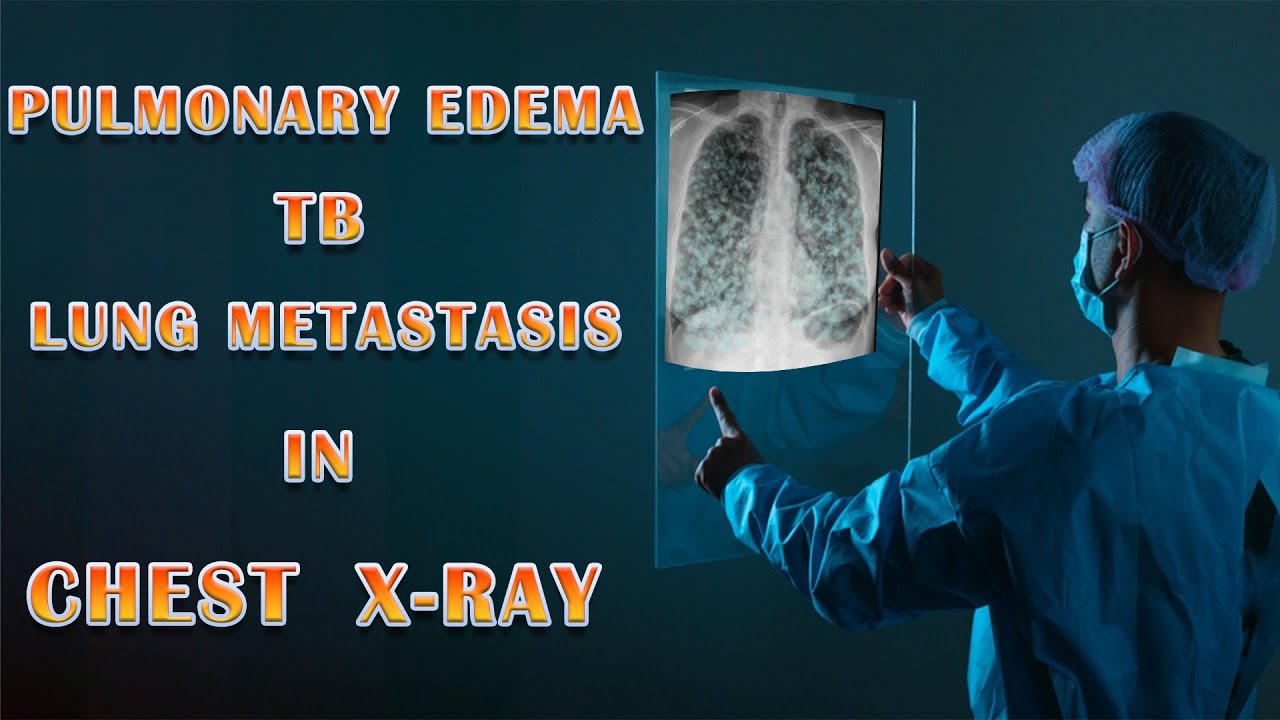 Chest X-Ray - 03 - ll Diffuse Opaque Lesions In Chest X Ray ll
