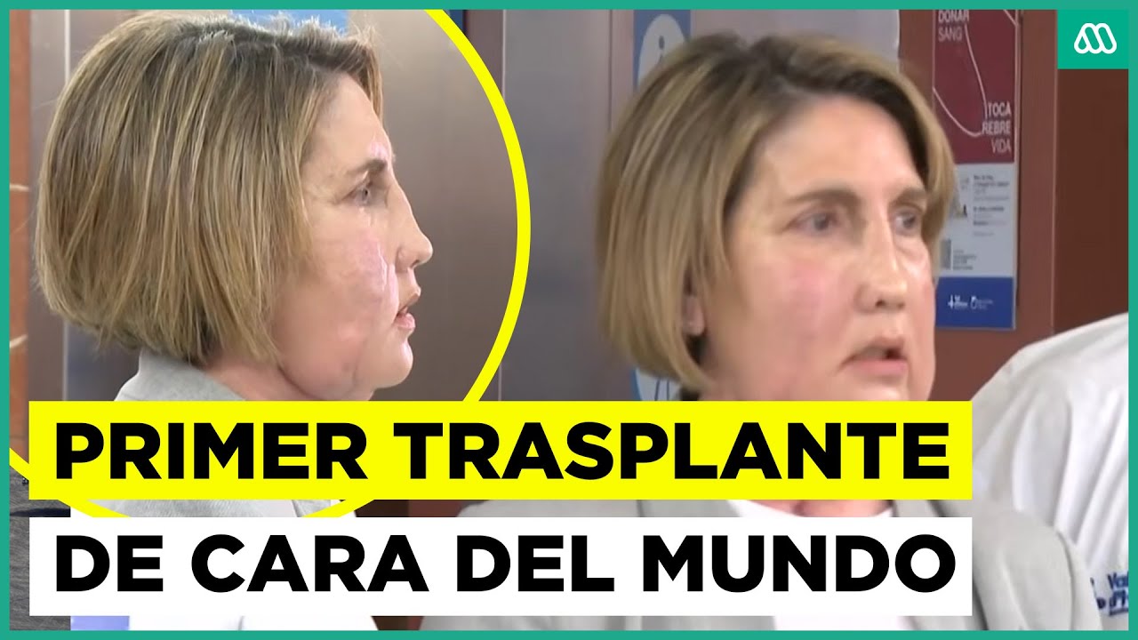 España realiza con éxito el primer trasplante de cara del mundo con donante que recibió eutanasia