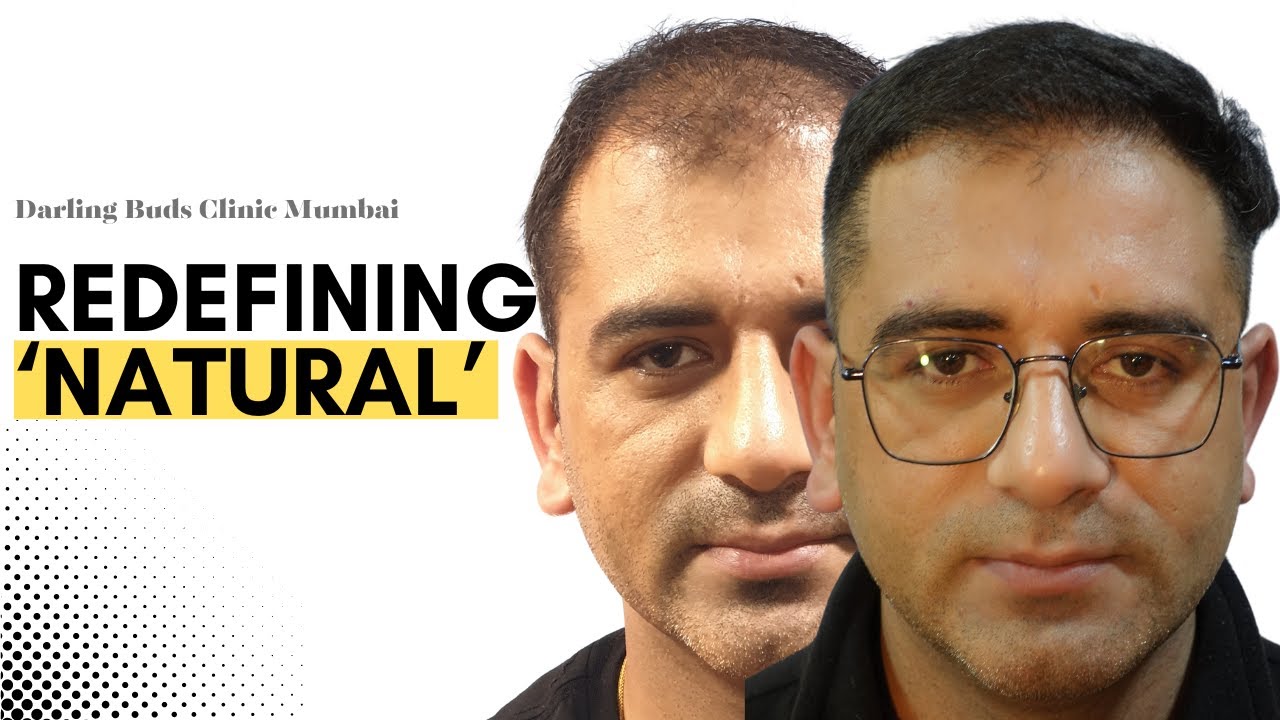 Hair Transplant in Mumbai | Best hair transplant results and cost of hair transplant