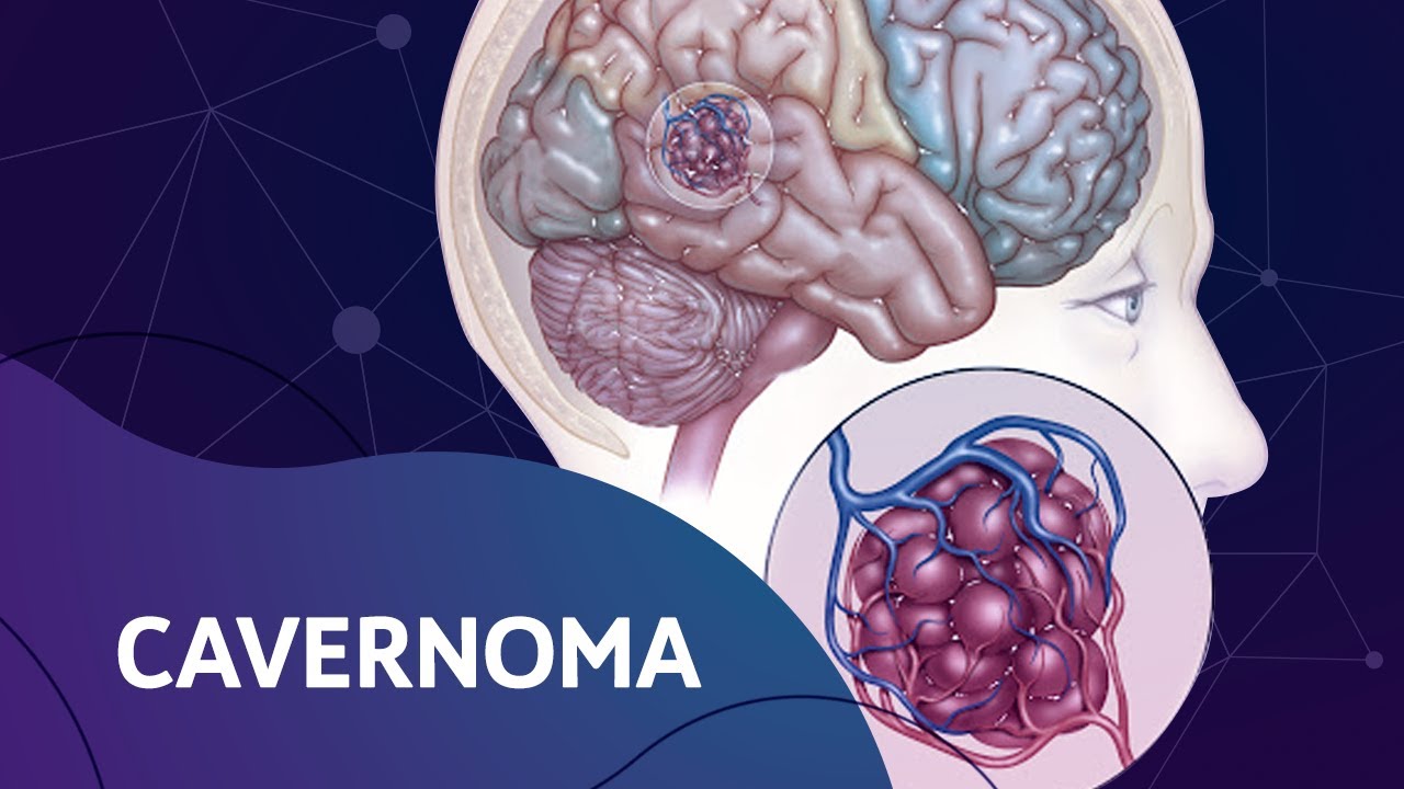 Cavernoma