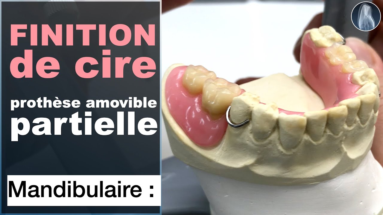 🎨 Sculpter la Fausse Gencive pour une Prothèse Amovible Partielle Mandibulaire : Tutoriel Complet 🦷✨
