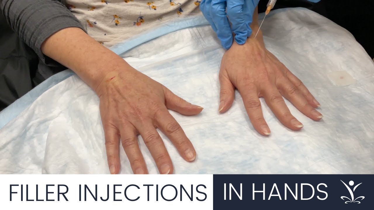 Filler Injections in Hands!