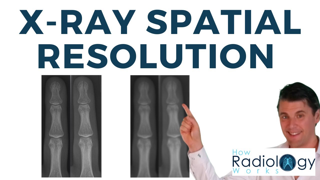 X-ray Spatial Resolution (focal spot, motion, detector)