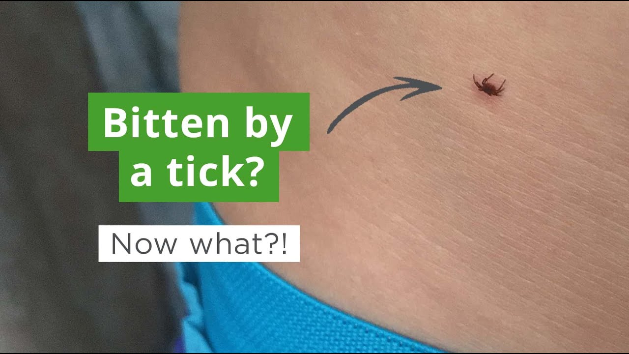 How to Remove a Tick | What To Do if You Get Bitten by a Tick