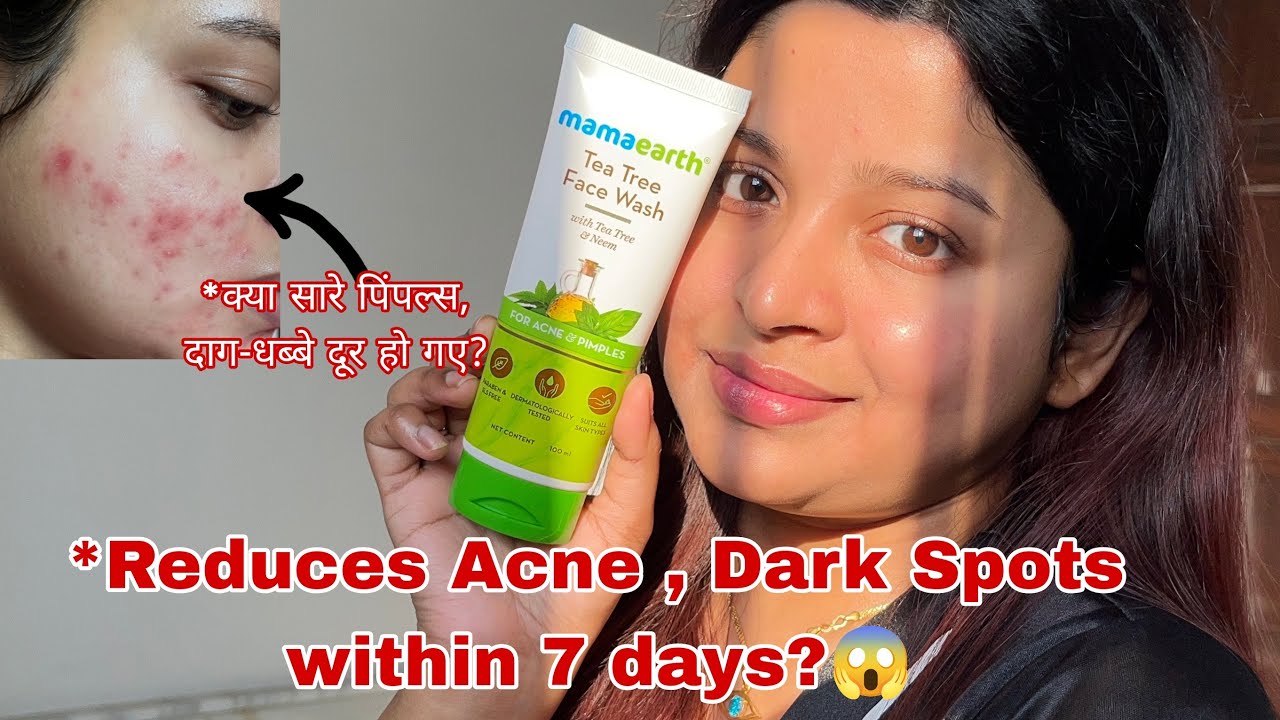 Mamaearth Tea Tree Face Wash Honest Review || Reduces Acne , Pimples & Blemishes within 7 Days?