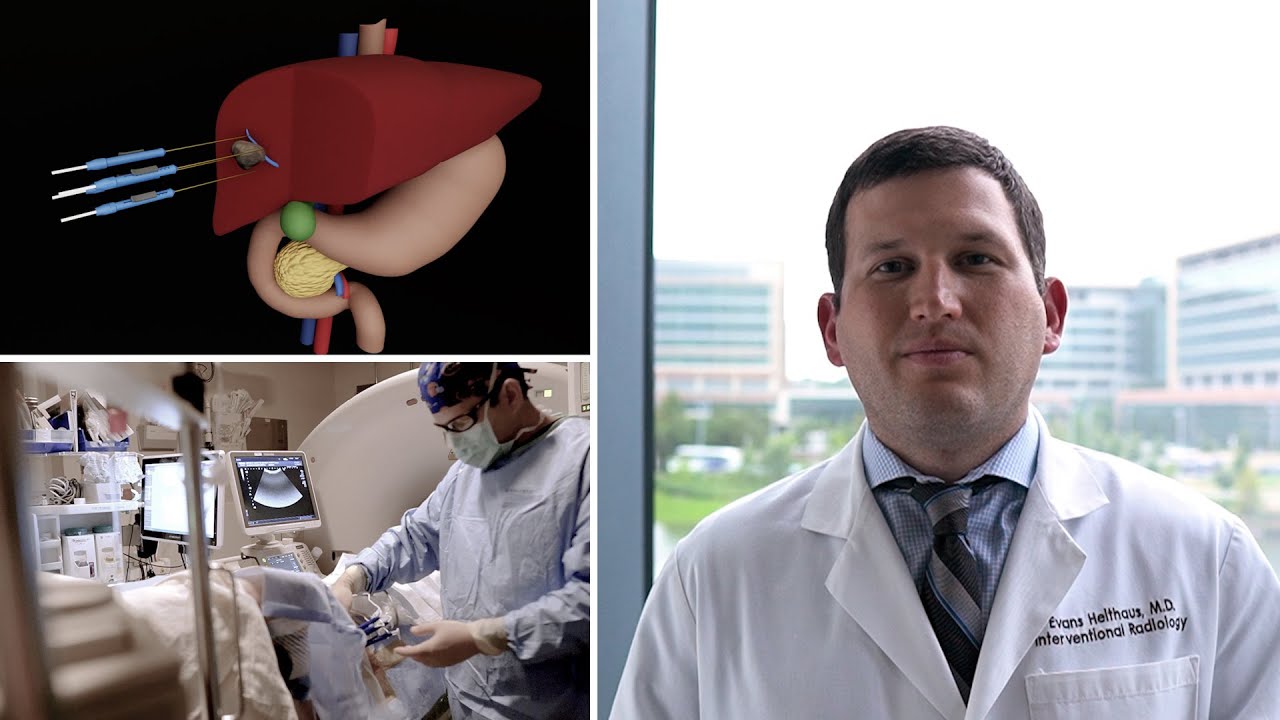 NanoKnife - Robert Evans Heithaus, MD