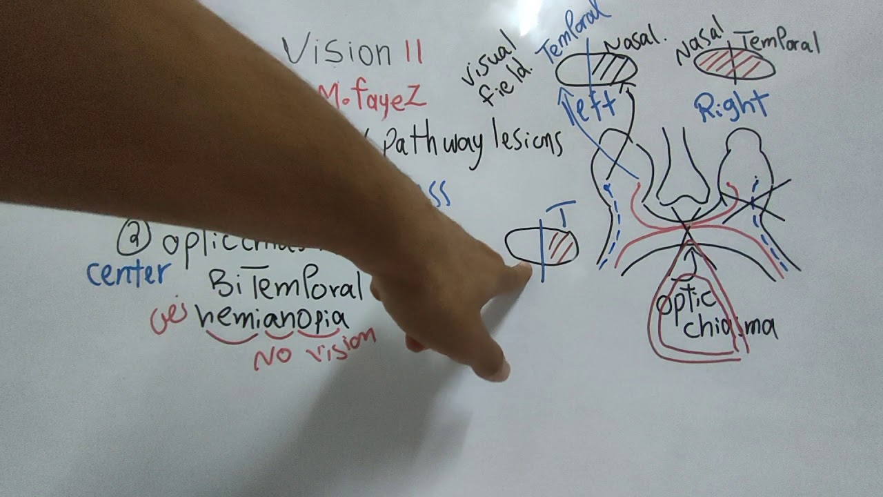 #Special_Sense_Dr_Mohamed_Fayez_Visual_Pathway_Lesions + Visual_Field