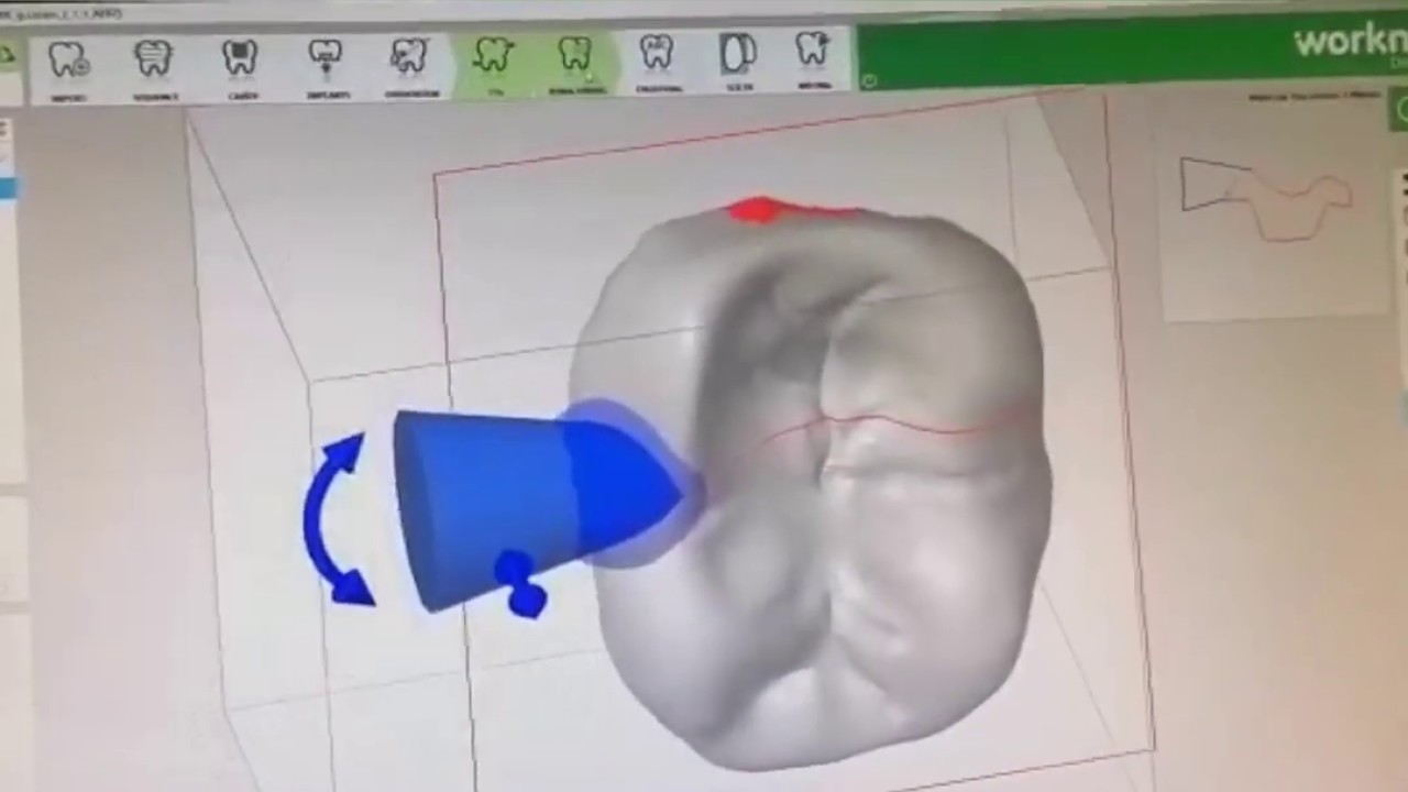 CAD-CAM SİRONA .DENTAL WİNGS . REDON CNC.(EXTENSION CONSTRUCTION WITH DATA CNC WITH ORAL SCANNER.)