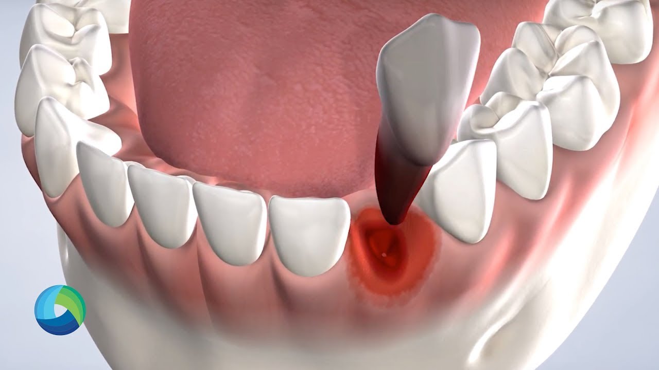 General Tooth Extractions in New Brunswick, NJ at Oral Surgery Group