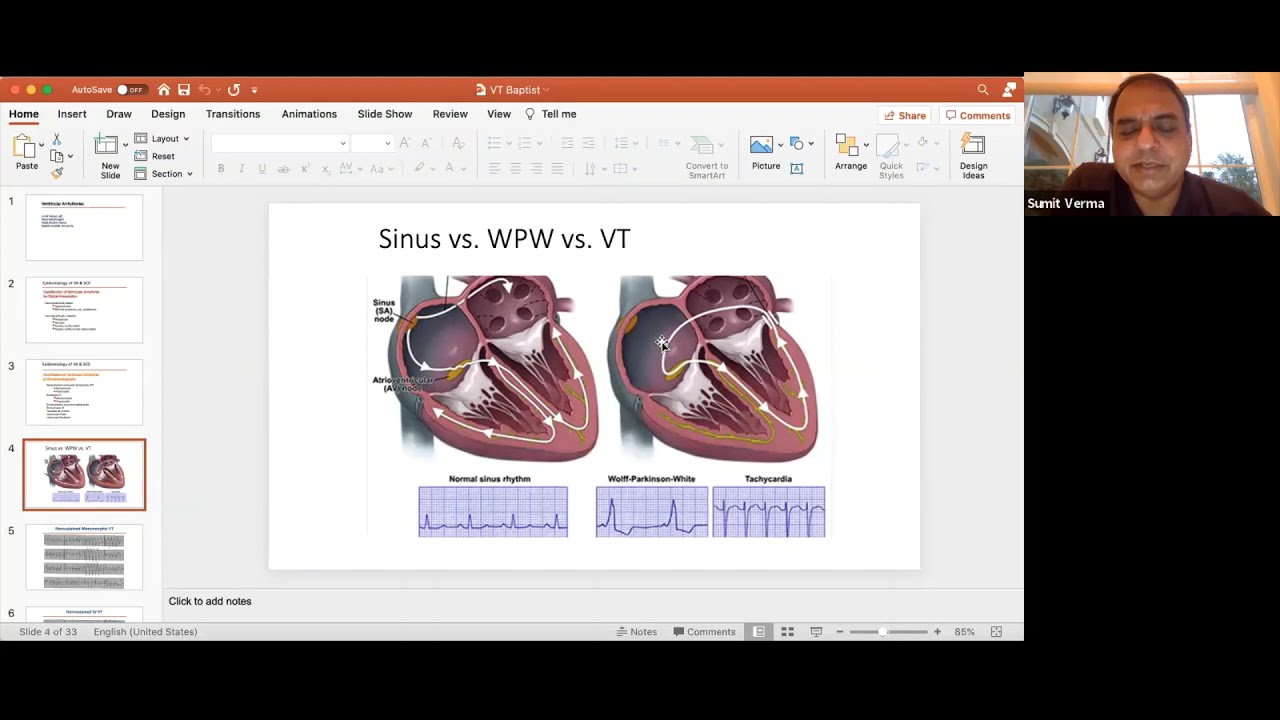 Ventricular Arrhythmias: EP Webinar with Dr. Verma