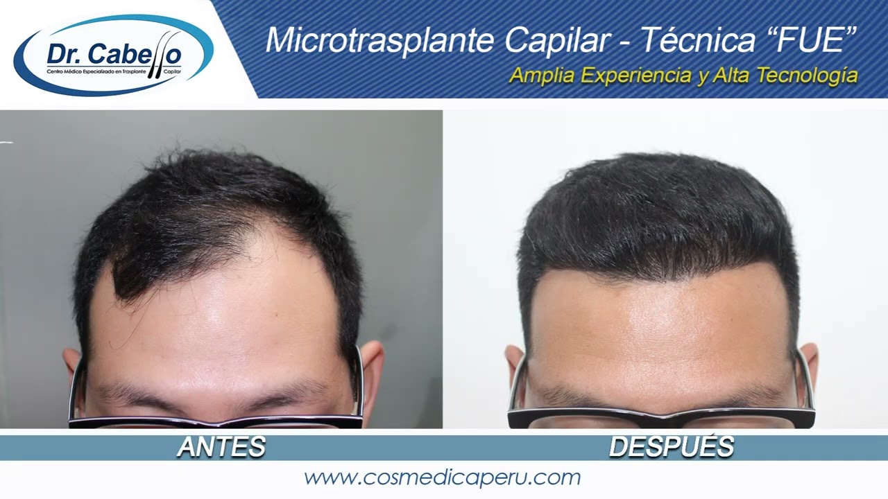 ‼️EXCELENTE RESULTADOS DE CASO DE 5000 UNIDADES FOLICULARES A 5 MESES DE SU TRASPLANTE‼️
