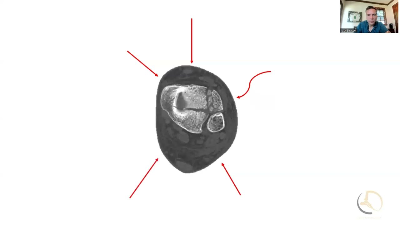 NLS anterior approach to the ankle