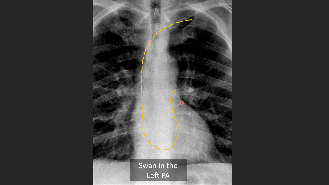 Swan Ganz Catheter Positioning on CXR