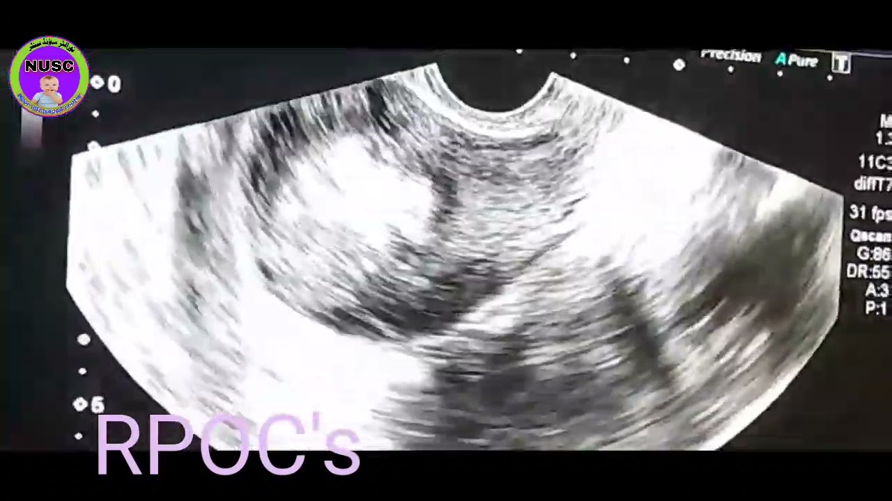 RPOC's | Retained products of conception | retained tissue after d&c | ultrasound