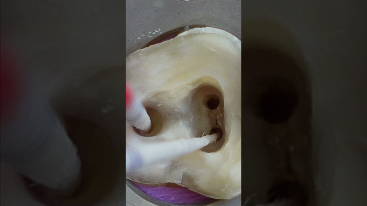Root Canal Treatment Of Molar Tooth In 4K | Amazing Restoration |