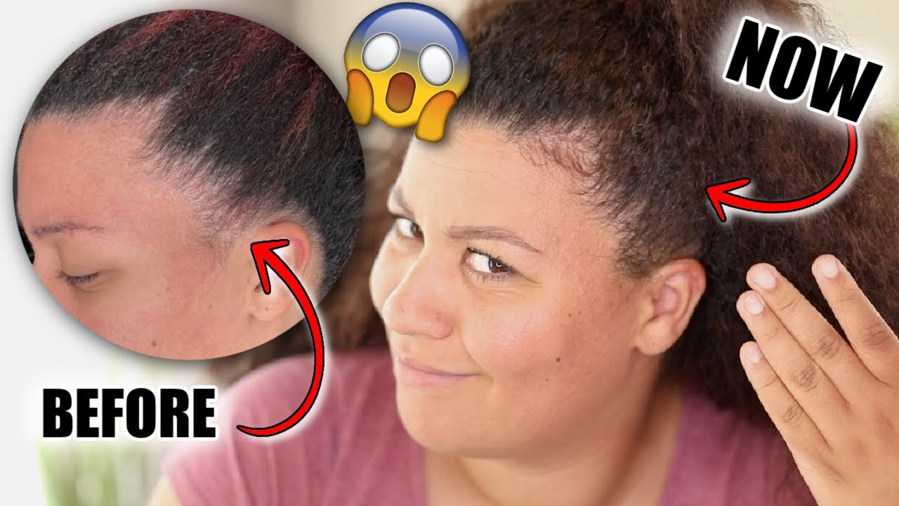 Unbelievable hair growth in just 30 DAYS 😱 My edges grew back with this ALL-NATURAL product