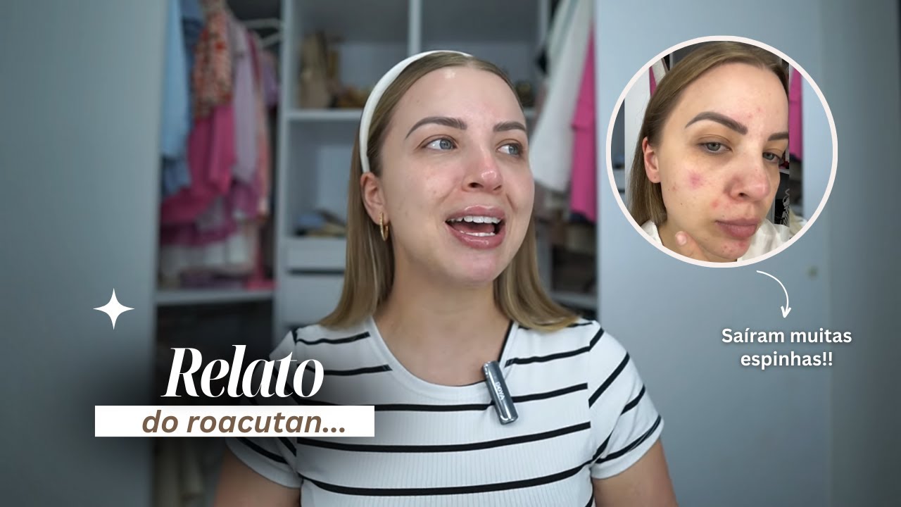 50 dias tomando roacutan, vale a pena? Efeitos colaterais & produtos de skincare que uso!