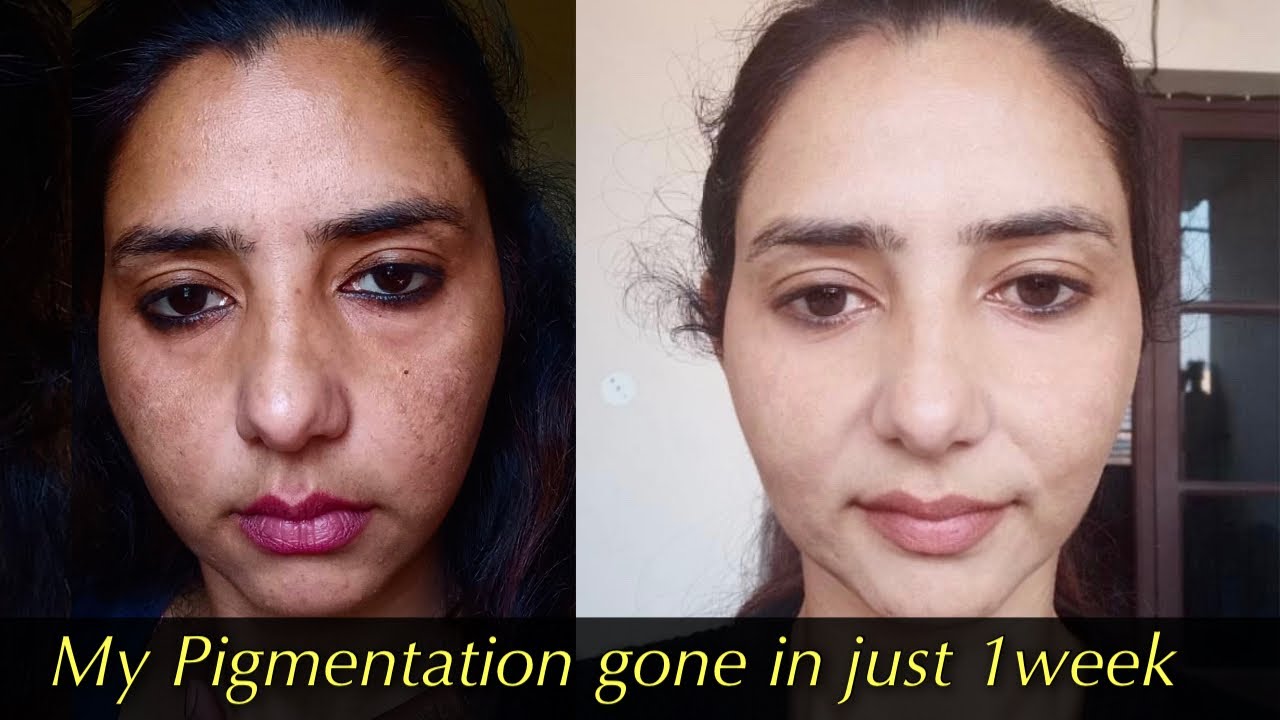 1 हफ़्ते में ही झाइयाँ ग़ायब हो गयी आपकी Diet से। My Pigmentation/Melasma gone in just 1 week.