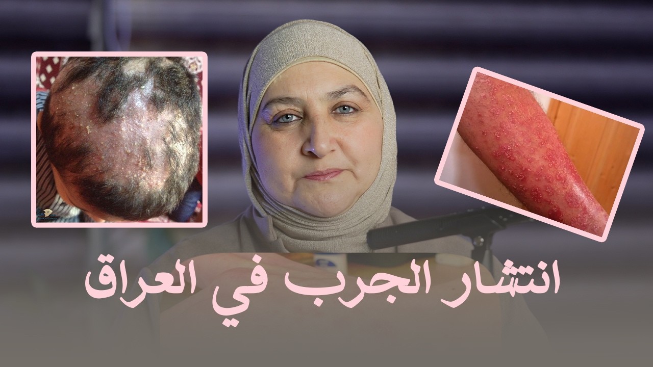 انتشار الجرب في العراق |  تحذير مهم للجميع لمرض قد يهدد حياتك