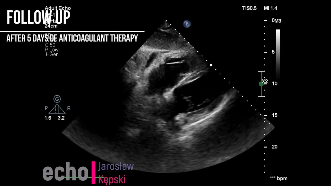 Acute Pulmonary Embolism and Follow Up- echocardiography and CT scan deep vein thrombosis ultrasound