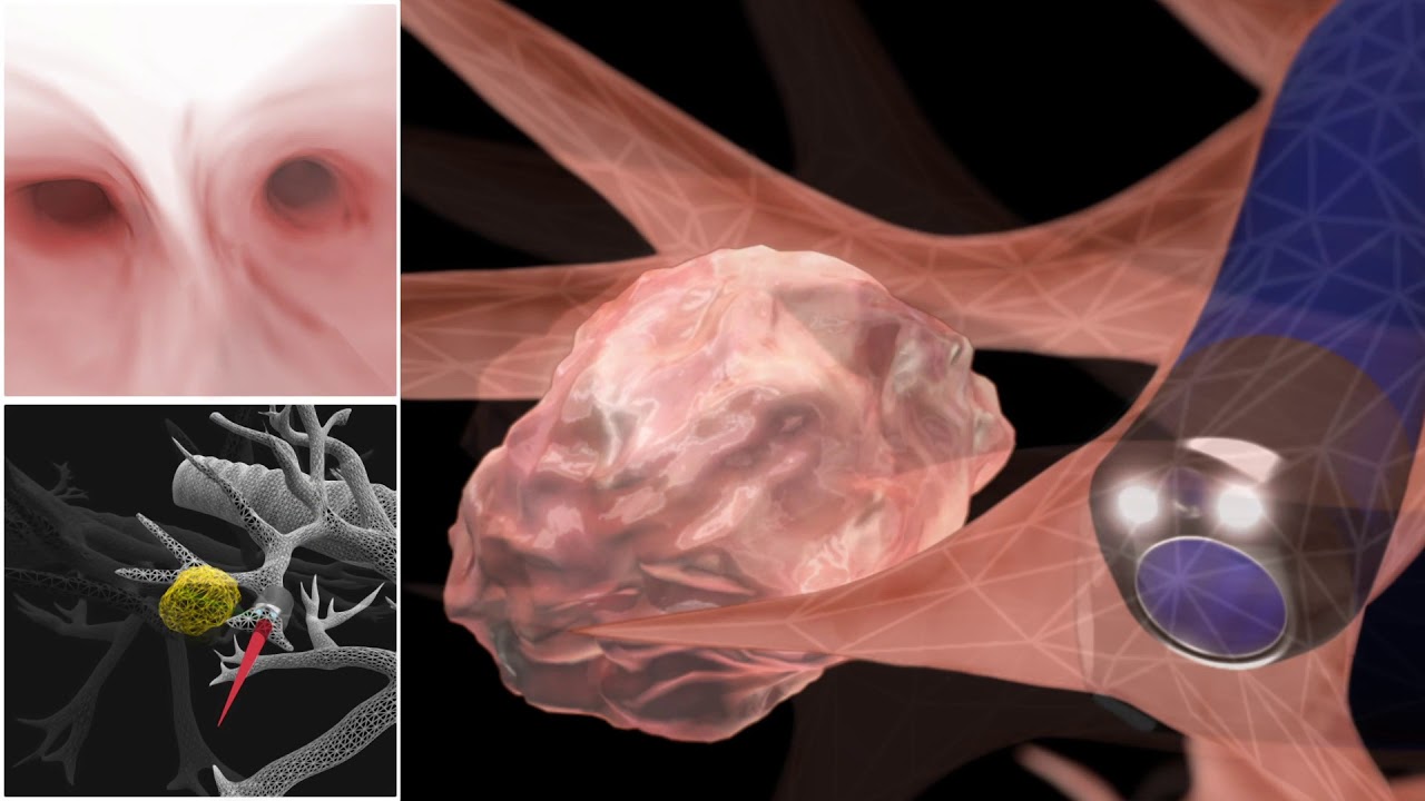 Dr. Karen Swanson on Robotic Bronchoscopy - Mayo Clinic