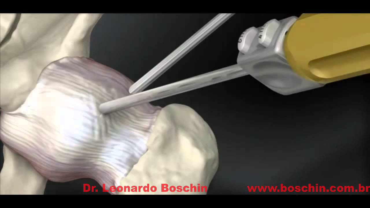 Artroscopia de Quadril