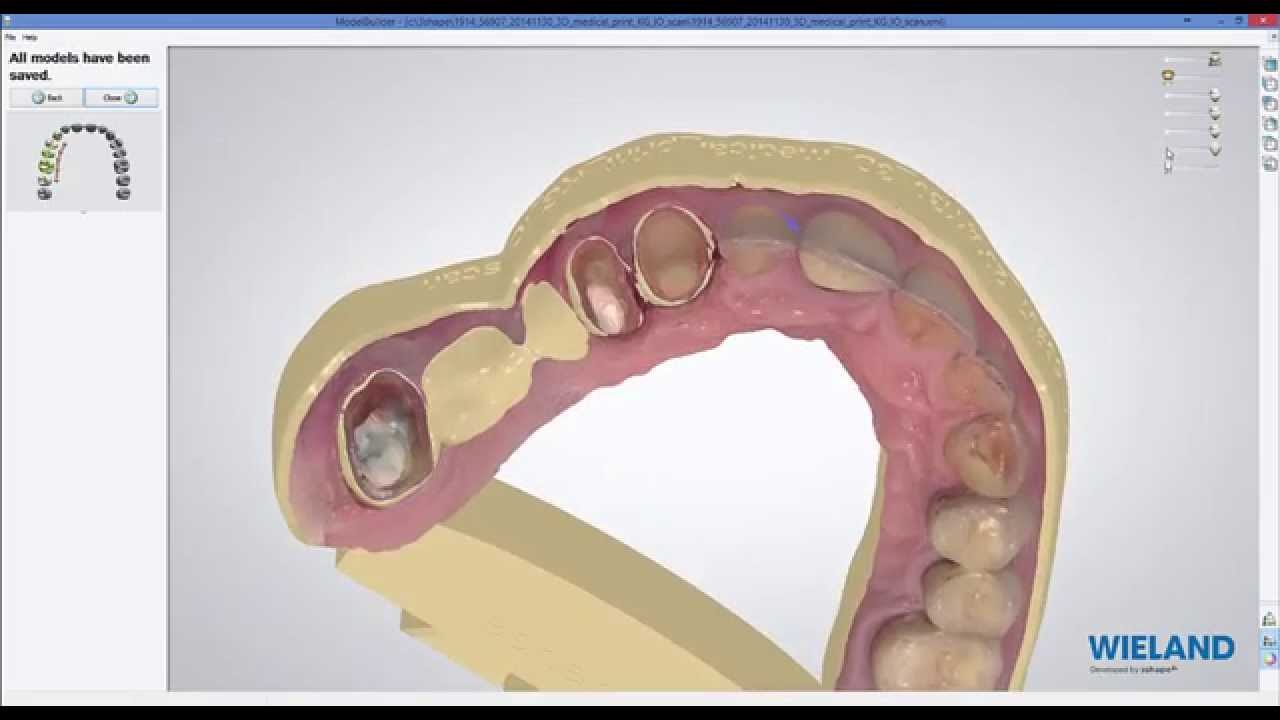 designing a dental model from a Trios Scan (3shape)
