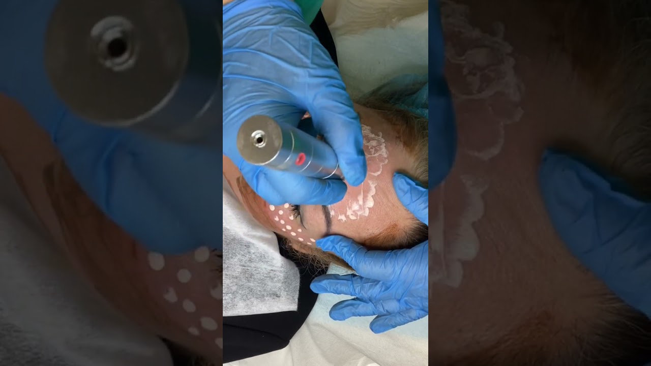 Curso Dermapen 2023. Paso-a-paso  Tratamiento BB Glow