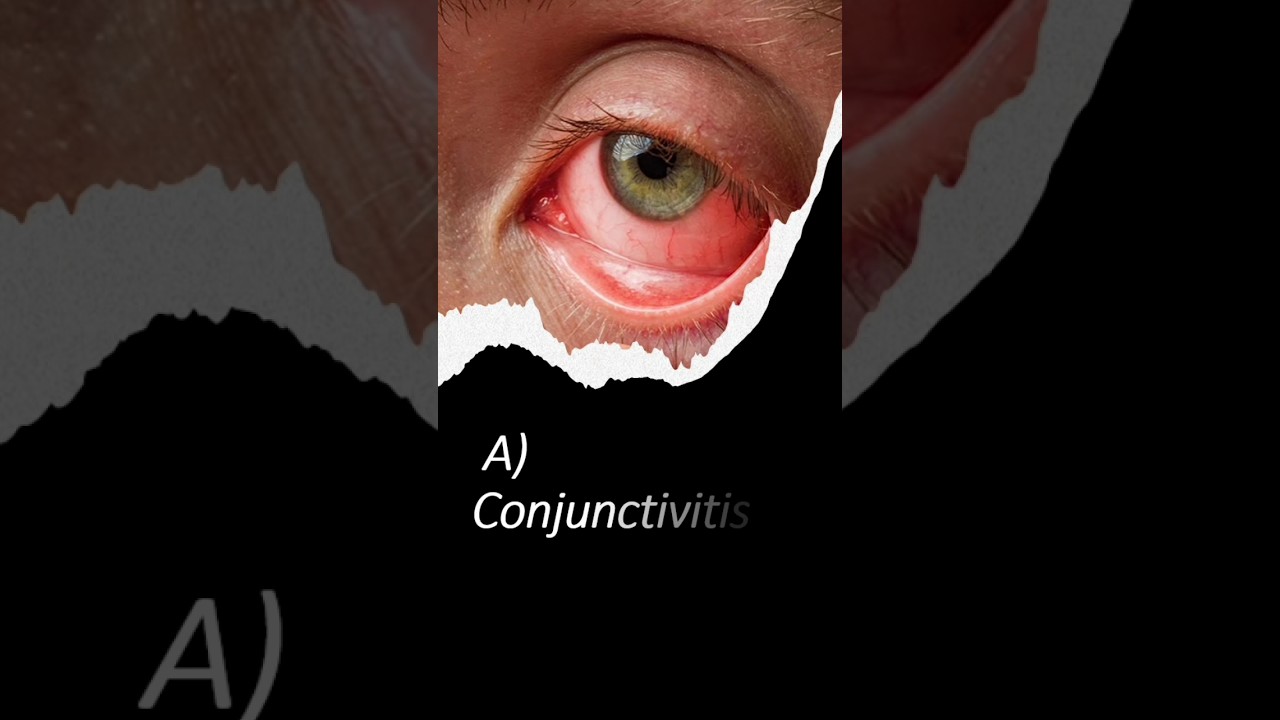 Pink Eye Infection Q01 of 50 | 