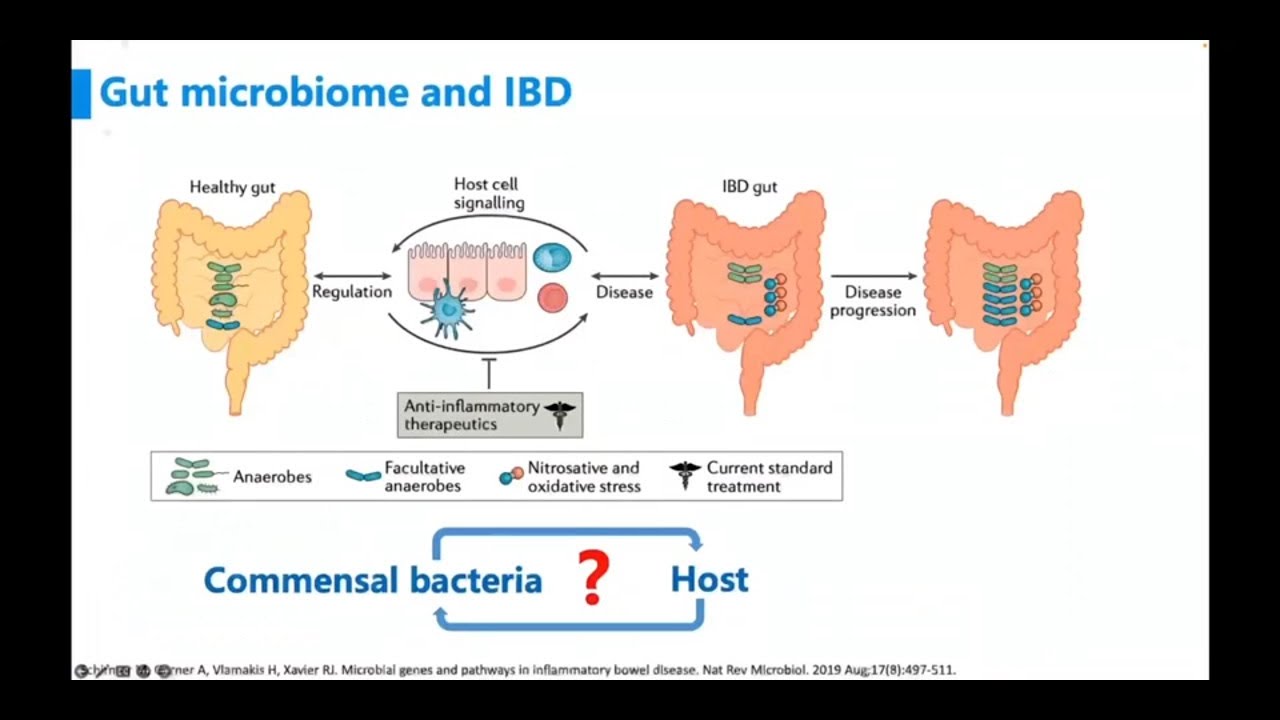 Enterococcus faecalis aggravates Crohn’s disease by inducing gut dysbiosis