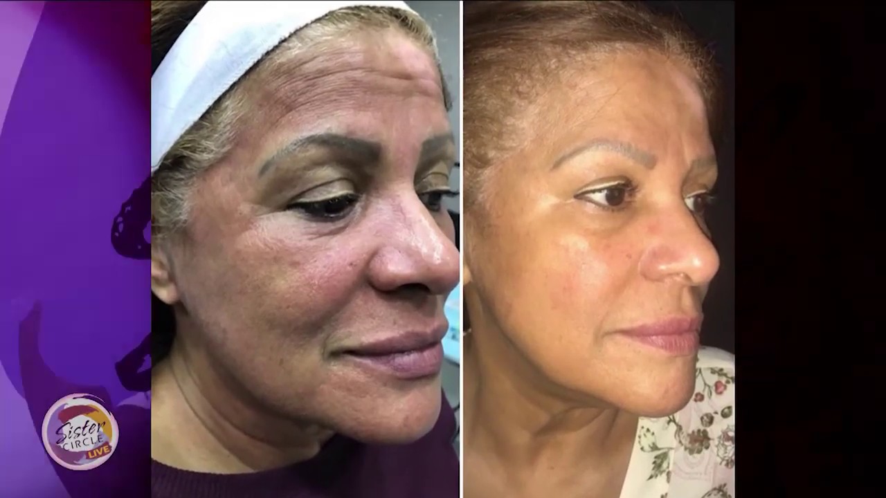Sister Circle | Are Skin Lasers Good For Women Of Color? | TVONE