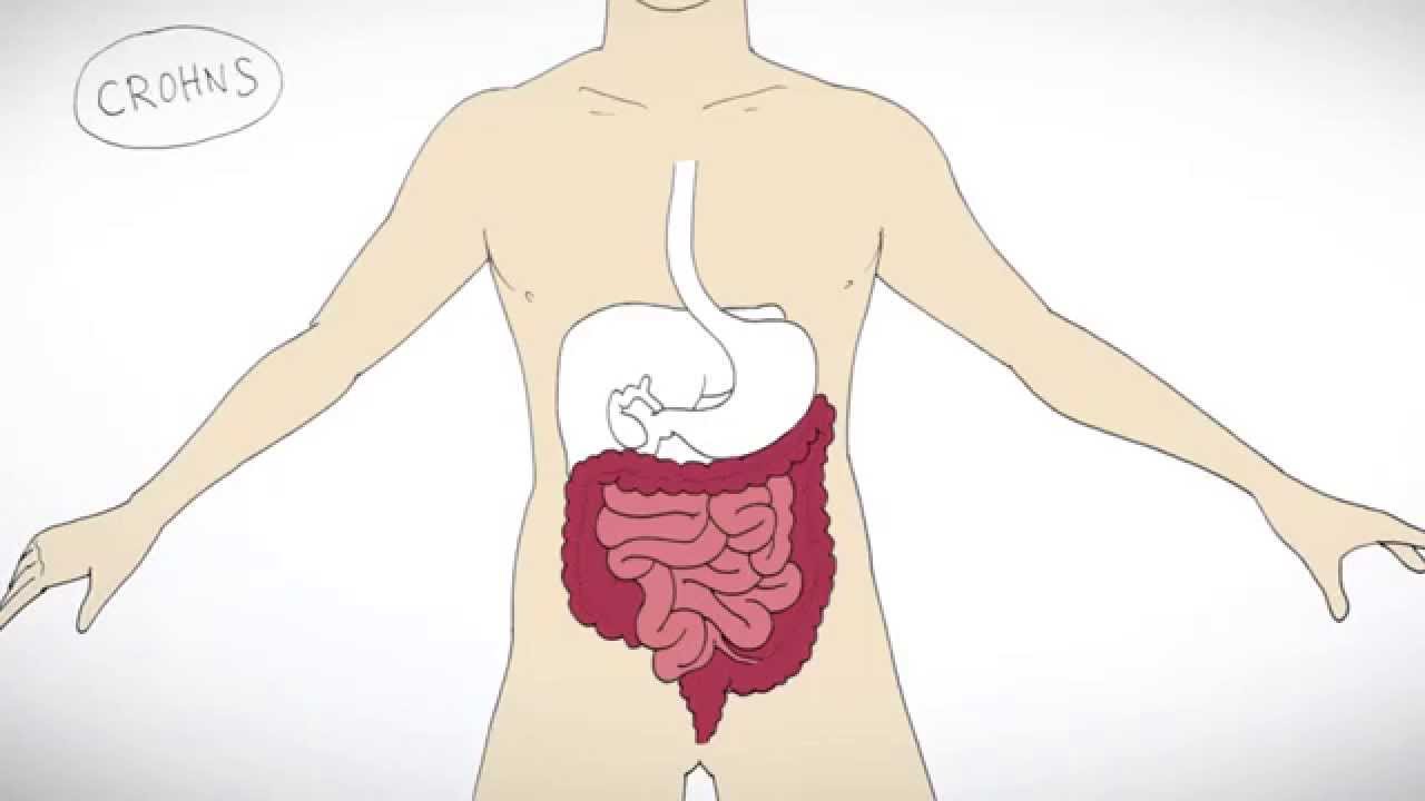 Å leve Morbus Crohn/Crohns sykdom