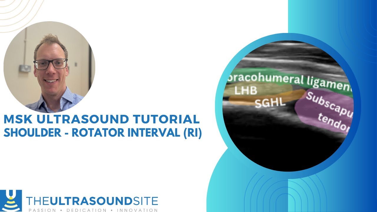 How to find the rotator interval on shoulder ultrasound!