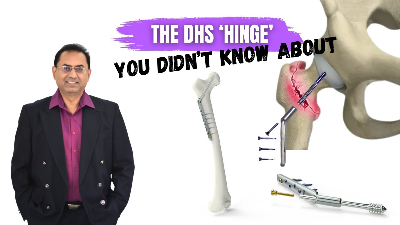 Dynamic Hip Screw EXPLAINED: The Hidden 