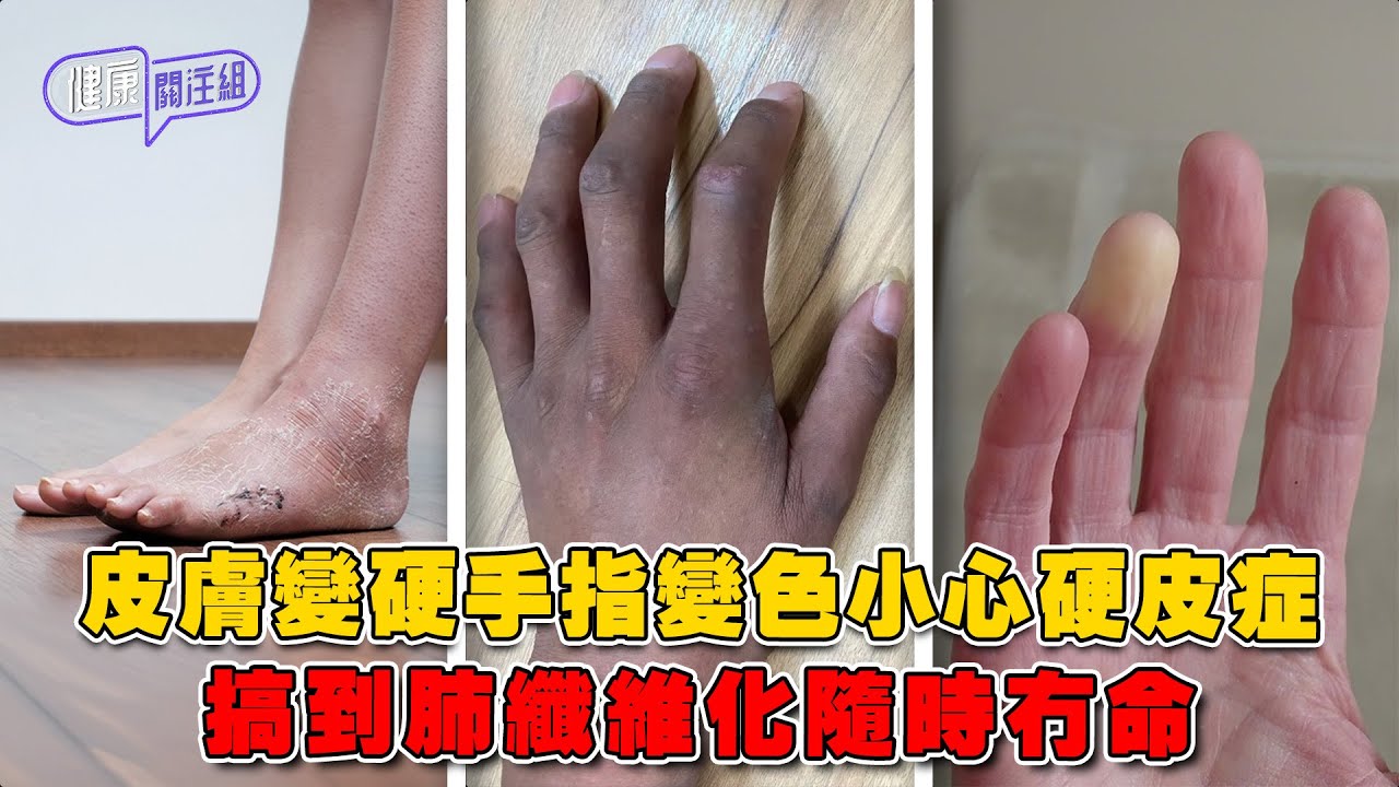皮膚變硬手指變色小心硬皮症 搞到肺纖維化隨時冇命 ｜ 健康關注組 ｜ EP507 ｜ 硬皮症 ｜ 肺纖維化 ｜ 手指變色 ｜ 皮膚變硬 ｜ 吳雲甫 ｜ 黃芳雯 ｜ HOY TV 77台