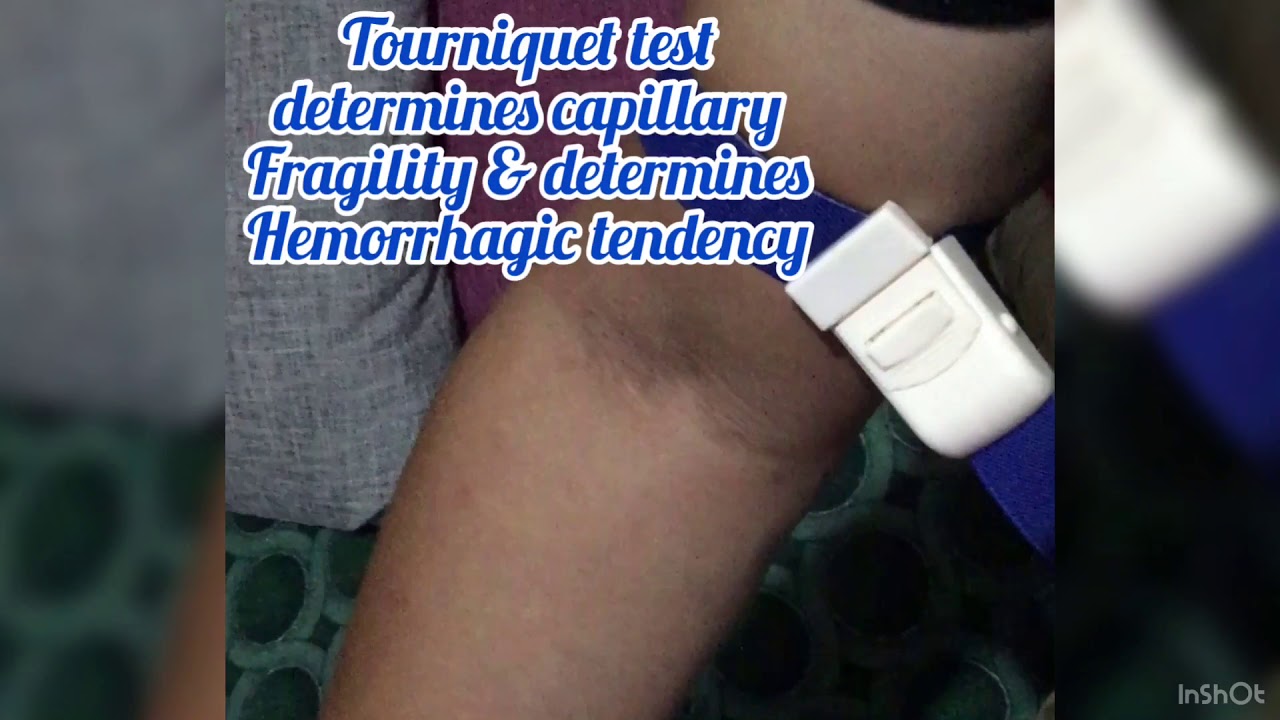 VLOG 6: Knowing Dengue Fever through Tourniquet Testing