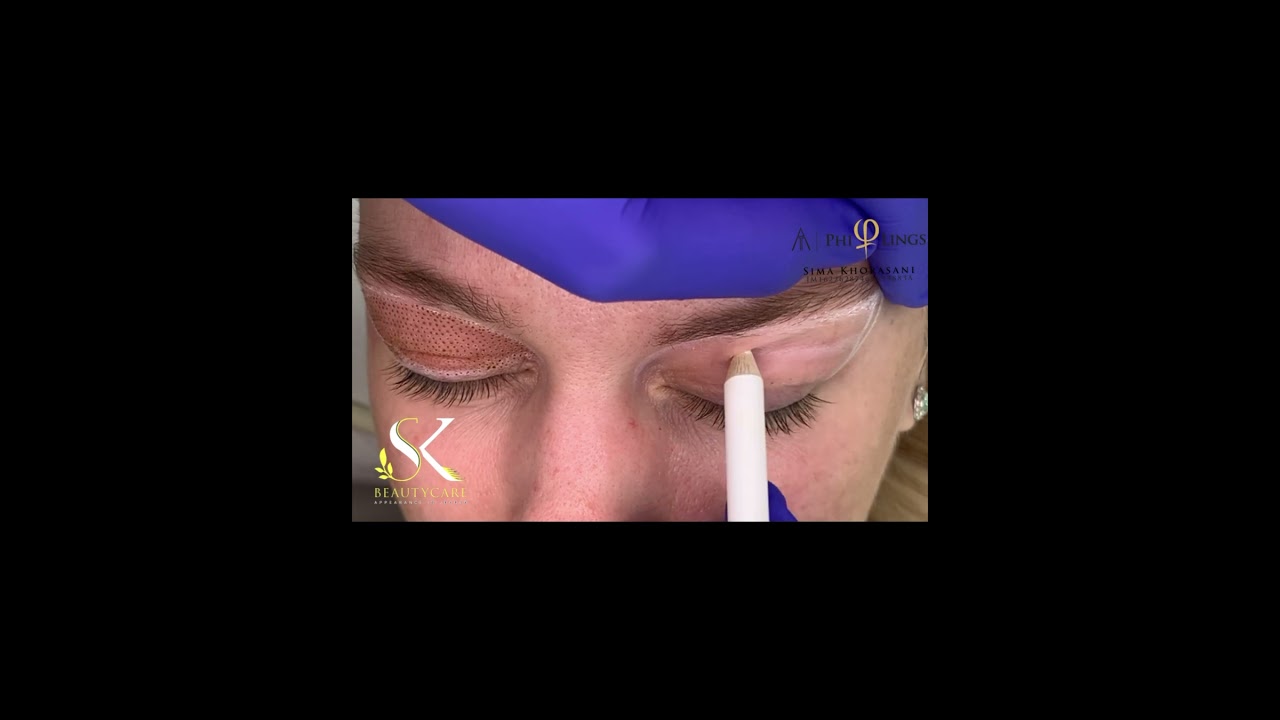 Plasma Fibroblast Philings technique