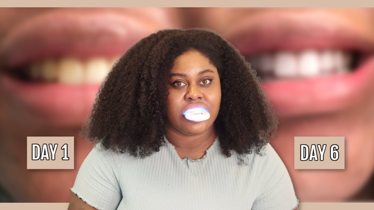 Набор для самостоятельного отбеливания зубов Amazon: MYSMILE