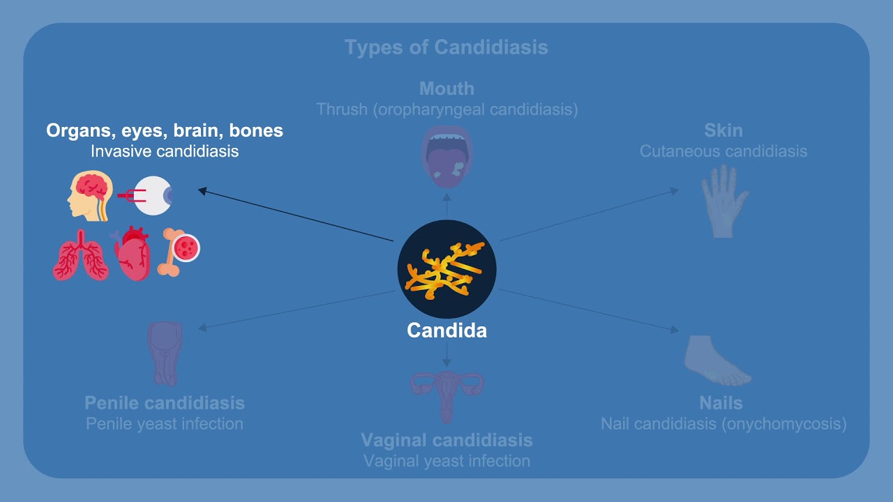 Overcoming Challenges in the Diagnosis and Treatment of Invasive Fungal Infections