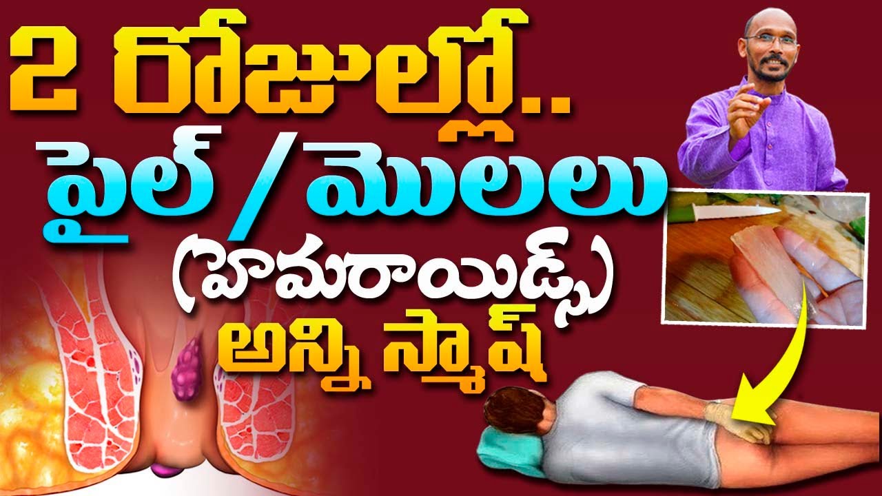 2 రోజుల్లో పైల్స్ / మొలలు (హెమరాయిడ్స్) అన్ని స్మాష్ !! | Dr. MadhuBabu | Health Trends |