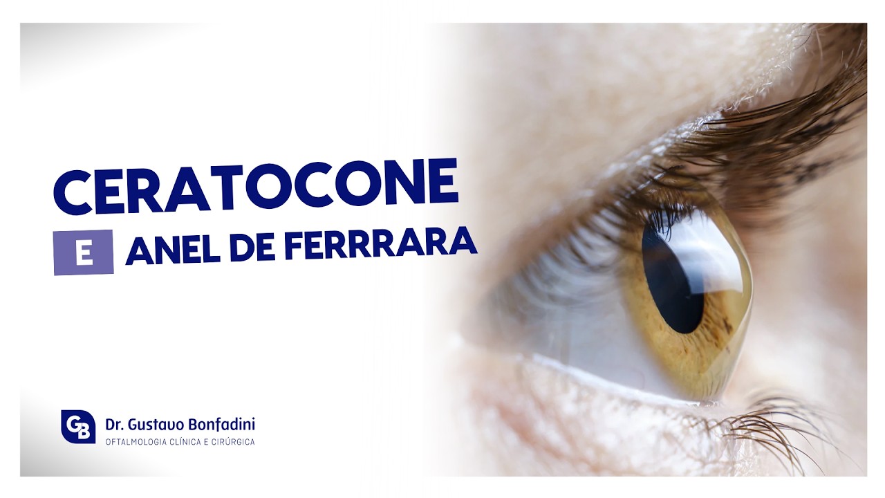 CERATOCONE E ANEL NO OLHO: COMO FUNCIONA A CIRURGIA QUE PODE SALVAR A SUA VISÃO !